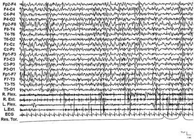 Frontiers Electro clinical features and management of the late